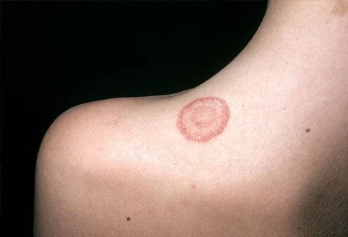 Μεγάλη προσοχή σε αυτά τα σημάδια στο σώμα – Μην τα αφήσετε να εξαπλωθούν!